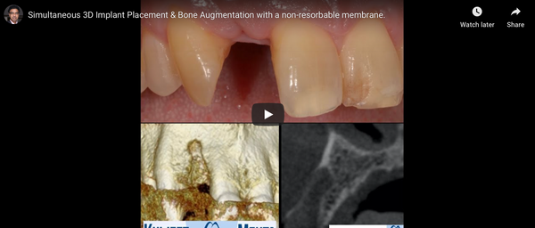 [Surgery] AnyRidge Implant Placement with R2 Stent, GBR with i-Gen Membrane-Upper Lateral Incisor.