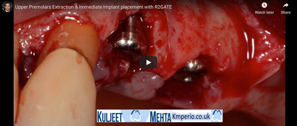 [Surgery] Upper Premolars Extraction & Immediate Implant placement with R2GATE