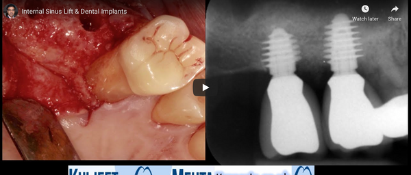 [Surgery] Internal Sinus Lift & AnyRidge Dental Implants